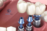 New Dental Implant Technology in 2025