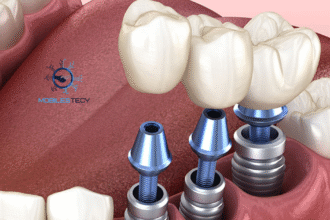 New Dental Implant Technology in 2025