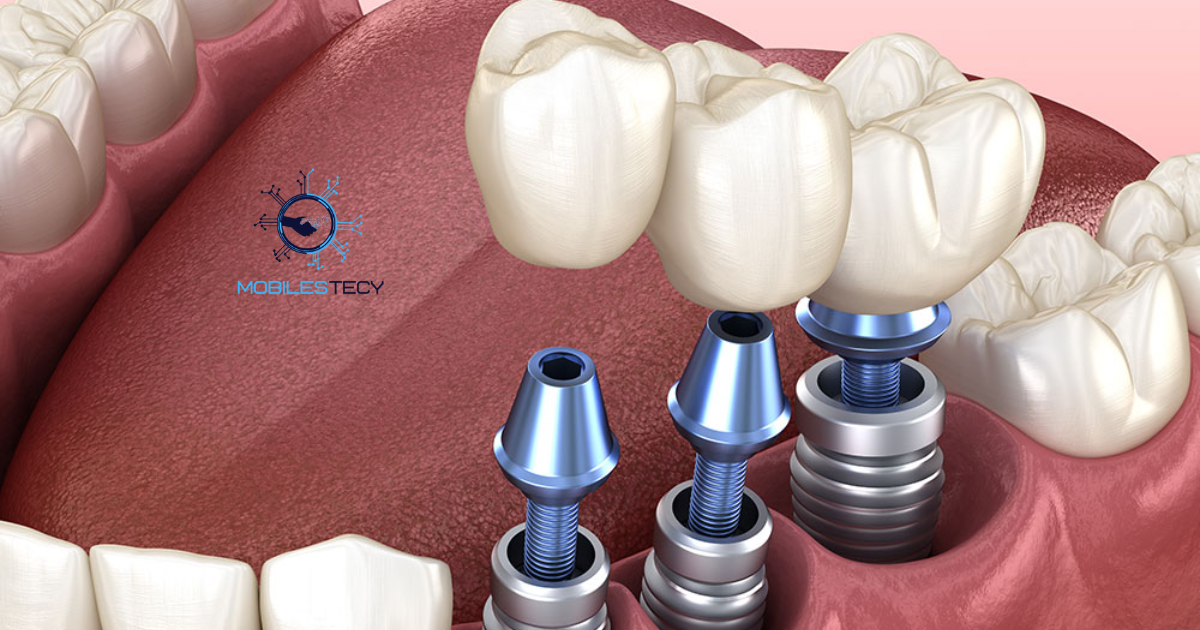New Dental Implant Technology in 2025