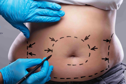 Does Health Insurance Cover a Tummy Tuck​?