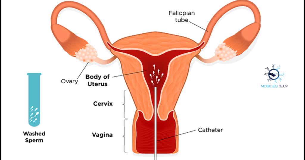 Insurance Coverage for IUI